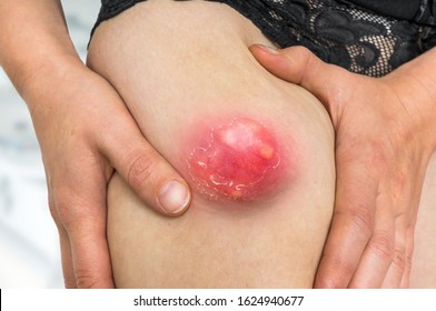 Big Pimple High Res Stock Images Shutterstock