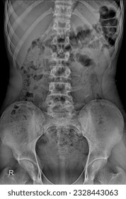 Detailed X-ray image of the KUB region, revealing the bony structures of the pelvis along with the urinary organs, aiding in the assessment of urinary tract conditions. - Shutterstock ID 2328443063