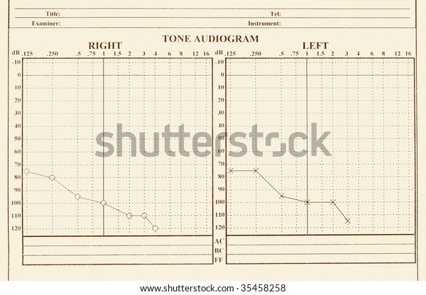 Audiology Chart