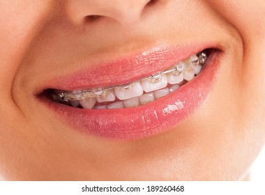 Details of teeth with braces isolated - Shutterstock ID 189260468