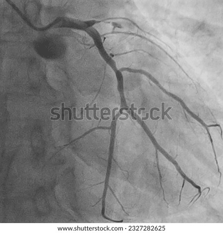 Detecting Coronary Artery Disease: The Role of Coronary Angiography