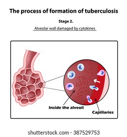 The development of tuberculosis. Stage 2. Infographics. illustration on isolated background.