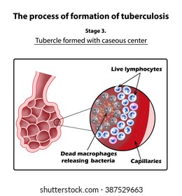 The development of tuberculosis. Stage 3. Infographics. illustration on isolated background.
