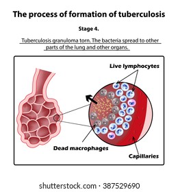The development of tuberculosis. Stage 4. Infographics. illustration on isolated background.