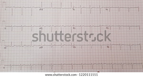 Dextrocardia Normal Sinus Rhythm Negative P Stock Photo 1220111551 ...