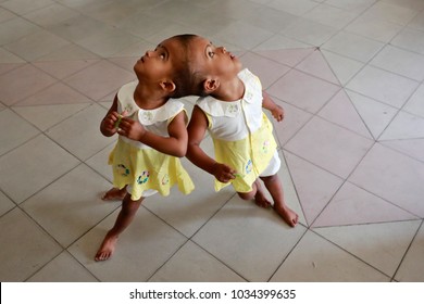 Siamese Twin Girls