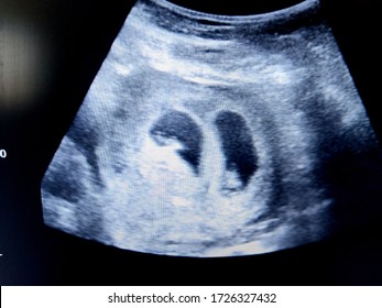 Twins ultrasound for Hidden Twin: