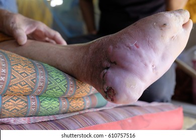 diabetes foot after toes amputation with inflammation - Shutterstock ID 610757516