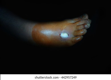 Diabetes foot , cut toe, infection wound,