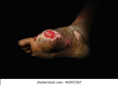 Diabetes foot , cut toe, infection wound,
