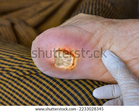 Diabetes foot ulcer in the foot of Asian  male patient.