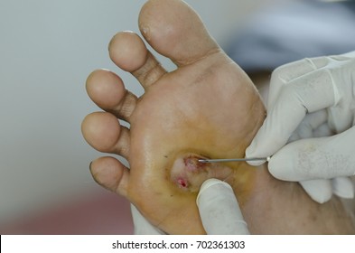 Diabetes foot wound.