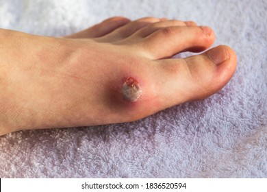 Diabetes mellitus of the foot. Infected wound, treatment of a diabetic patient's leg infection. Selective focus.