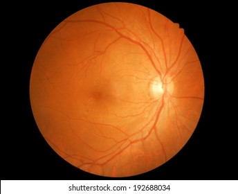 diabetes retinopathy - Retina isolated