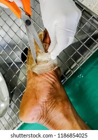 Diabetes Wound At Foot. Hand Of Nurse Cleaning Patient's Foot At Hospital Treatment Room.