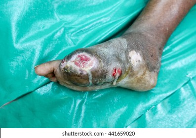 Diabetic Foot , Pus From Wound ,cut Toe