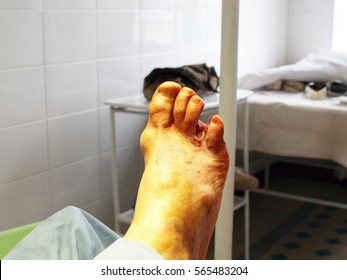 Diabetic Foot Syndrome. Operating. Amputation Of The Fourth Toe.