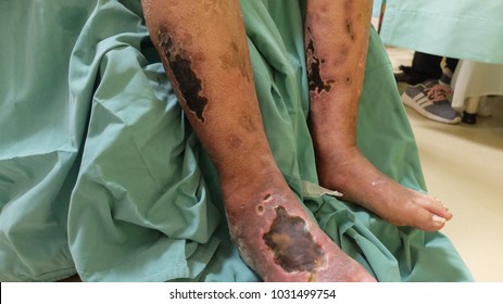 Diabetic Foot Ulcer With Chronic Limb Ischemia.