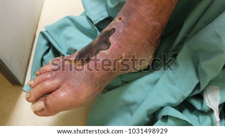 Diabetic Foot Ulcer with Chronic Limb Ischemia.