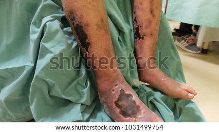 Diabetic Foot Ulcer with Chronic Limb Ischemia.