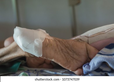 Diabetic Foot Ulcers. Gauze Bandage The Foot,treating Patients With Foot Ulcers.