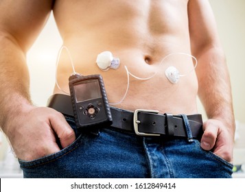Diabetic man with an insulin pump connected in his abdomen and keeping the insulin pump