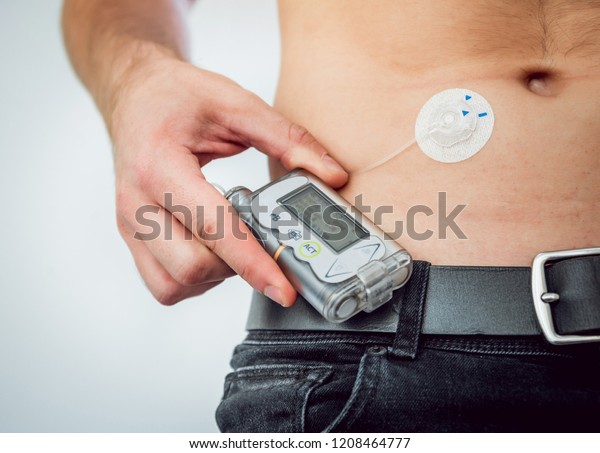 Diabetic man\
with an insulin pump connected in his abdomen and keeping the\
insulin pump on his belt. Diabetes\
concept.