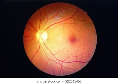 Diabetic retinopathy Photo medical from desktop.