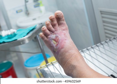 Diabetic Ulcer On Left Foot