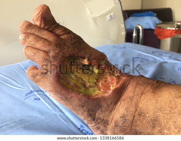 Diabetic Wound Foot Stock Photo (Edit Now) 1338166586