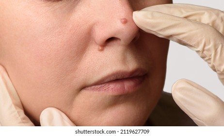 Diagnosis of skin mole or nevus on woman's face. Doctor's hands in surgical gloves examining nevi on nose. Checking moles concept. Closeup