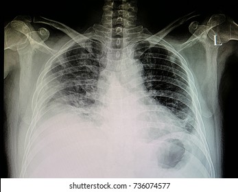 Diagnostic Chest X-ray Film Of A Patient With Cardiomegaly, Pulmonary Edema, And Pleural Effusion