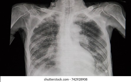 Diagnostic Chest X-ray Film Of A Patient With Cardiomegaly, Pulmonary Edema