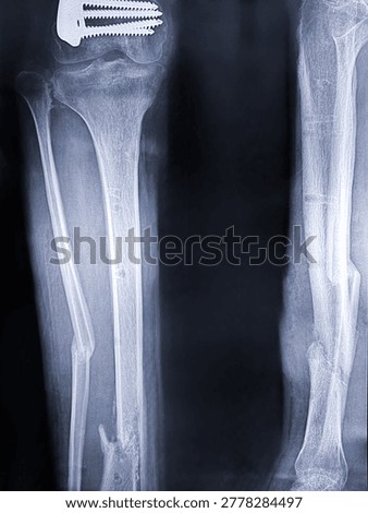 Diagnostic radiograph displaying severe comminuted fractures of the tibia and fibula shafts.