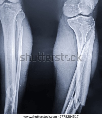 Diagnostic radiograph displaying severe comminuted fractures of the tibia and fibula shafts.