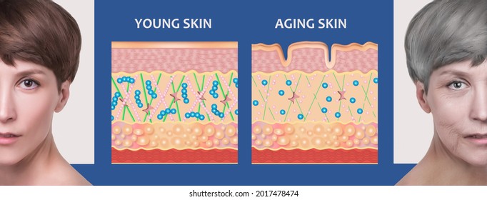 The diagram of younger skin and aging skin showing the decrease in collagen and broken elastin in older skin.