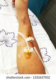 Dialysis With An Artificial Dialysis Machine Via A Large Blood Vessel In The Arm