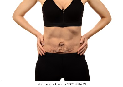 Diastasis Recti. Woman's Abdomen Divergence Of The Muscles Of The Abdomen After Pregnancy And Childbirth. Loose Skin On Belly.