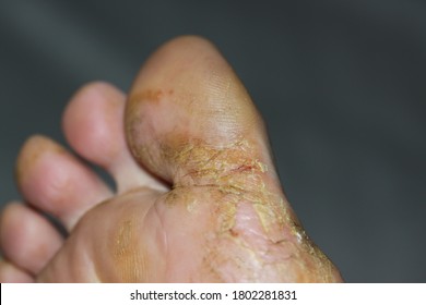 Diest, Belgium - June 12 2019: Cracked feet, flaky skin, medical need for athlete  foot. Image by Raphaëlla Goyvaerts