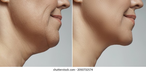 Difference after plastic surgery. Double chin removal, facelift and neck liposuction. - Shutterstock ID 2050732574