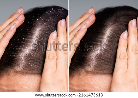 Difference Of Hair With Dandruff And Clean Hair Foto stock © 