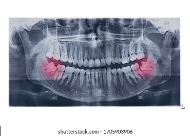 different types of wisdom teeth problems concept. Problem teeth X-ray image scanned