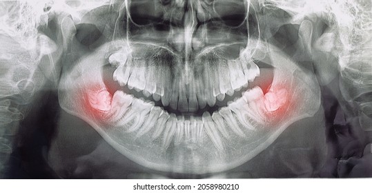 different types of wisdom teeth problems concept, problem teeth X-ray image scanned, panoramic image