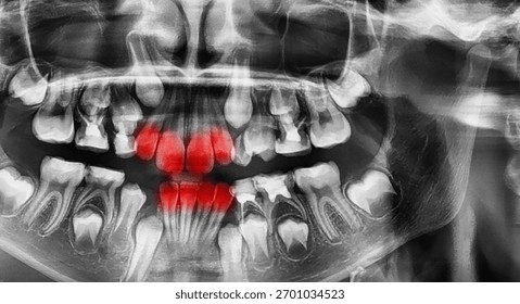 different types of wisdom teeth problems concept. Problem teeth X-ray image scanned
