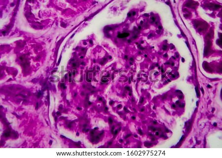 Diffuse proliferative glomerulonephritis, DPGN, light micrograph, photo under microscope. High magnification