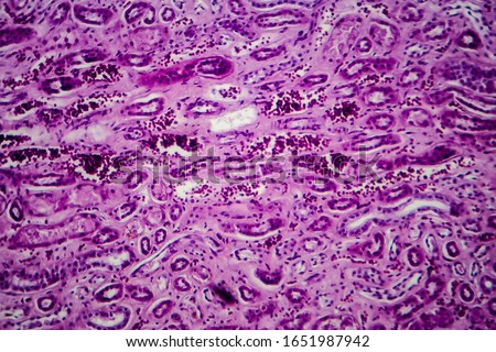 Diffuse proliferative glomerulonephritis, DPGN, light micrograph, photo under microscope