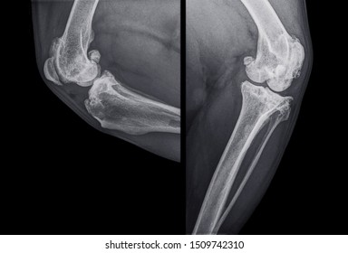 Digital X-ray Of The Knee Of A Dog With Severe Osteoarthritis In And Around The Knee Joint . Sideview And Frontal View. Isolated On Black