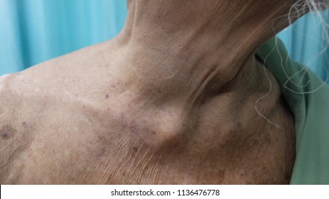 Dilated Superficial Veins secondary to Obstructed Superior Vena Cava. This is due to presence of Huge Goitre or Thyroid swelling with retrosternal extension.