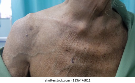 Dilated Superficial Veins secondary to Obstructed Superior Vena Cava. This is due to presence of Huge Goitre or Thyroid swelling with retrosternal extension.