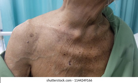 Dilated upper chest superficial veins due to Superior Vena Caval Obstruction. In this case patient has retrosternal Goitre.